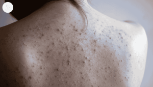 5 cách trị mụn lưng nhanh chóng giúp da láng mịn