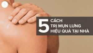 5 cách trị mụn lưng nhanh chóng giúp da láng mịn