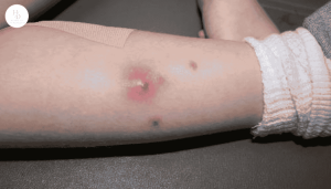 5 cách trị mụn nhọt tại nhà hiệu quả nhanh chóng