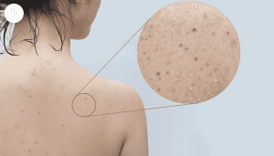 5 cách trị mụn lưng nhanh chóng giúp da láng mịn