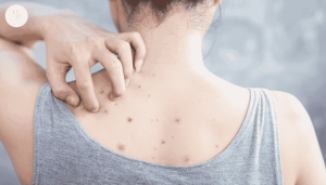 5 cách trị mụn lưng nhanh chóng giúp da láng mịn